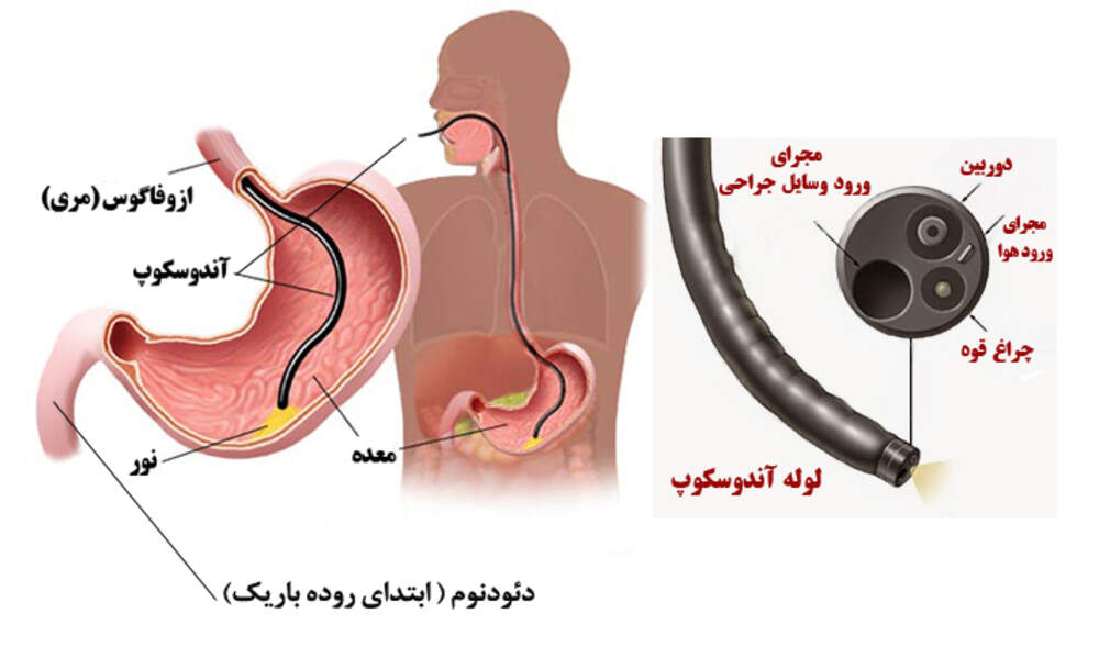 پیشرفتهترین دستگاه کلانژیوسکوپی در بیمارستان ابوعلی سینا شیراز
